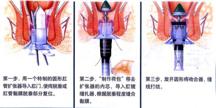 南山医院肛肠外科技术介绍---痔疮PPH手术