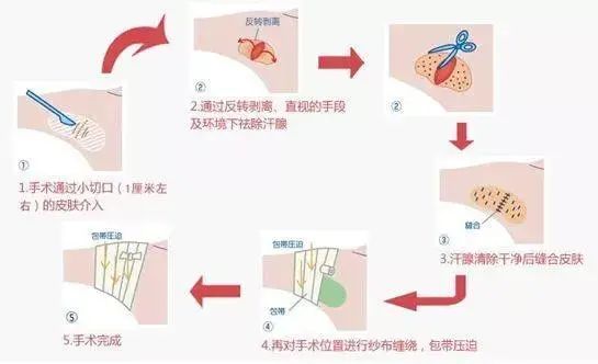 南山医院腋臭微创手术优惠活动及知识科普
